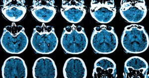 Terapia genética AMT-130: marco promete retardar Huntington em até 75%